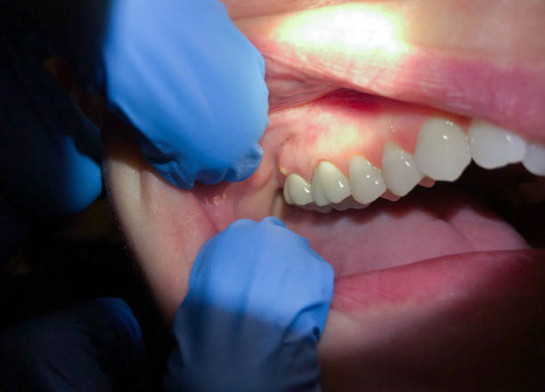 Best Dentist for Tooth Abscess  in Pablo, MT